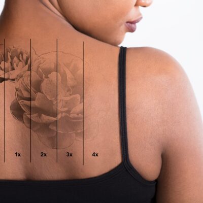 Tattoo Removal in Surrey: What You Need to Know