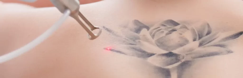 Tattoo Removal. Tattoo Laser Removal in Croydon